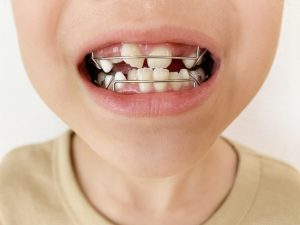 小児矯正はいつから始めるべき？年齢別の適切なタイミングを解説