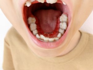 子供のあごが小さいと歯並びに影響する？早めに考えたい矯正治療