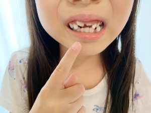 歯並びが悪いとむし歯になりやすい？子どものお口の環境と歯並びが関係する理由について